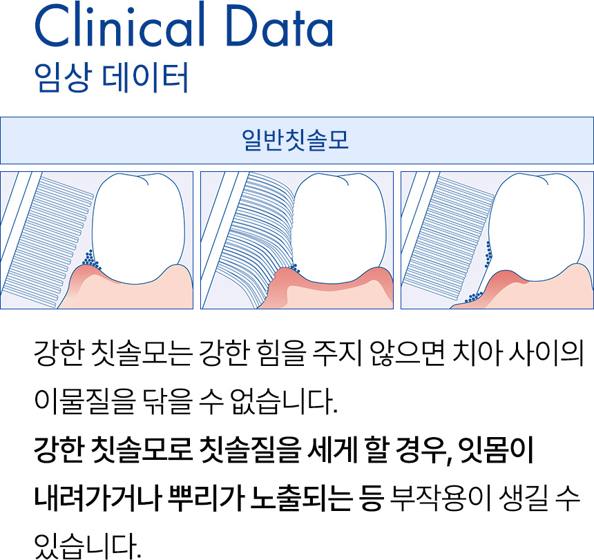 임상 데이터. 강한 칫솔모는 강한 힘을 주지 않으면 치아 사이의 이물질을 닦을 수 없습니다. 강한 칫솔모로 칫솔질을 세게 할 경우, 잇몸이 내려가거나 뿌리가 노출되는 등 부작용이 생길 수 있습니다.